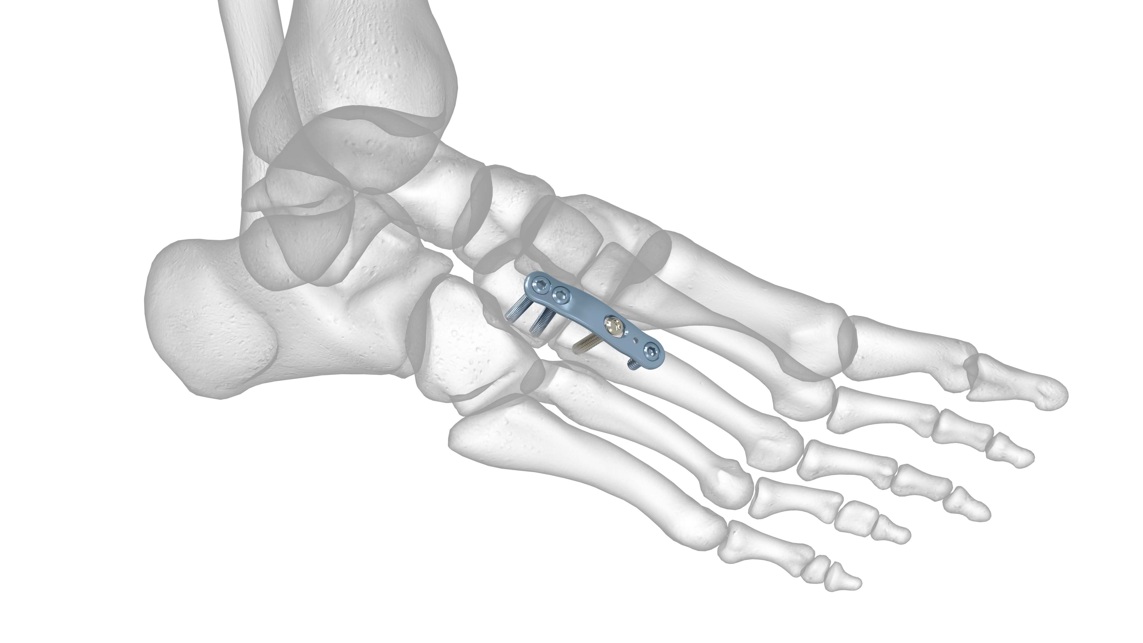 Locking 2nd 3rd TMT Plate Acumed